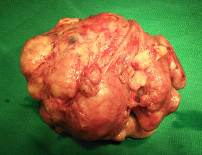 巨大子宮肌瘤併右側巨大卵巢瘤及重度貧血