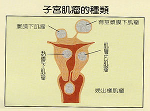 什麼是子宮肌瘤